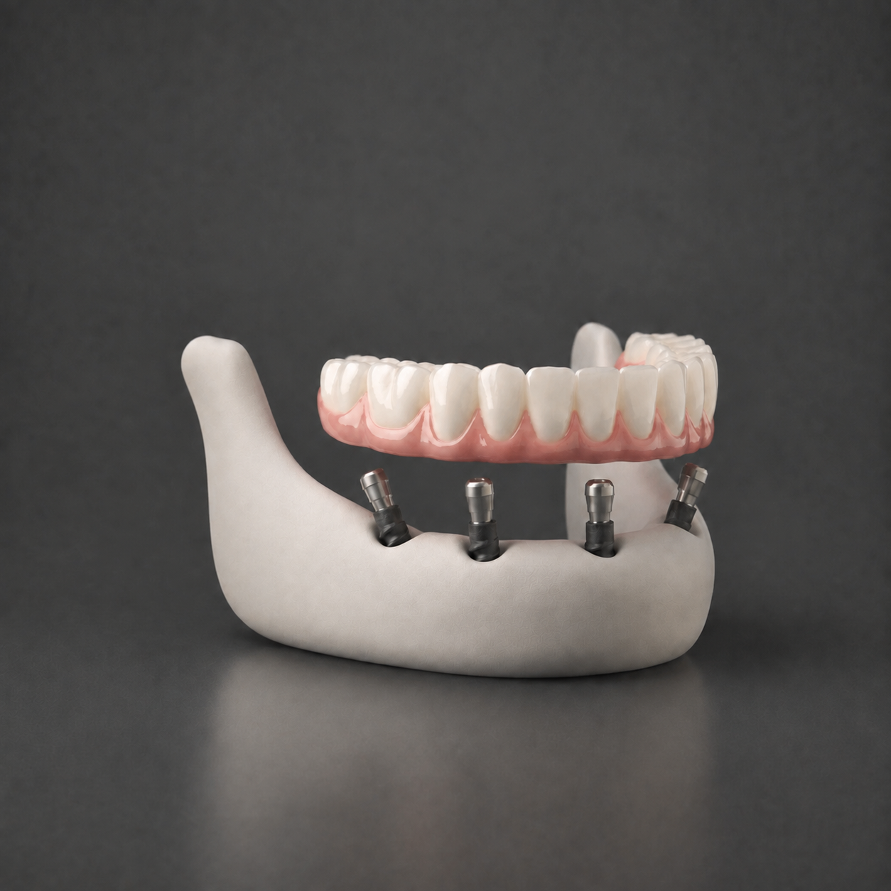 Full-arch implant-supported prosthesis shown at an angle above four jaw implants