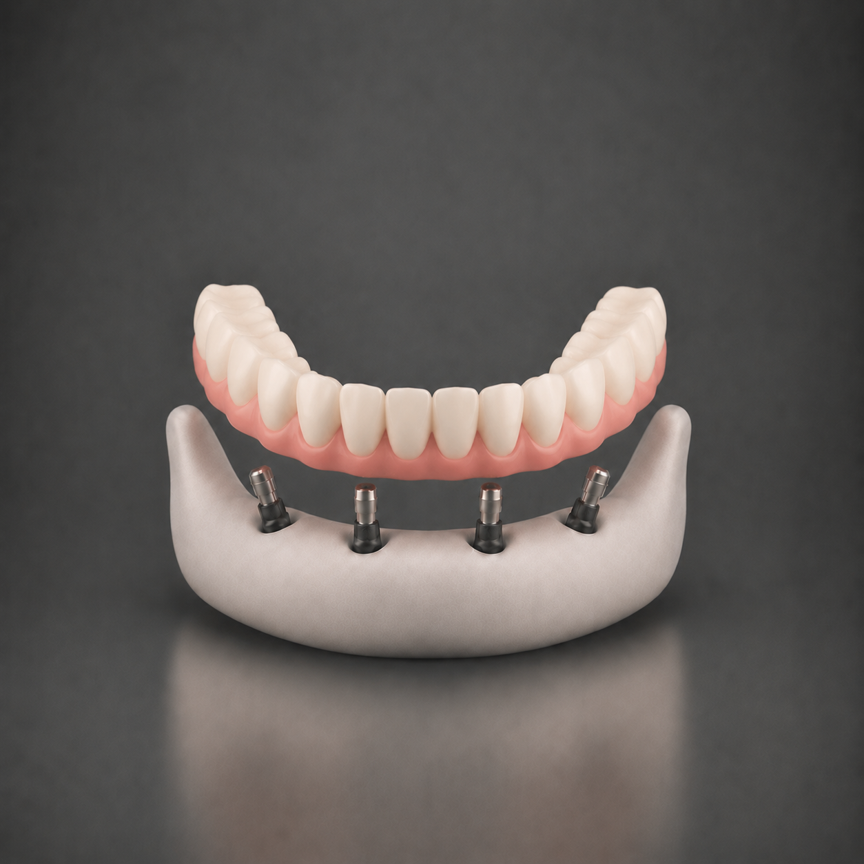 Full-arch implant-supported bridge shown straight on above four implants in the jaw